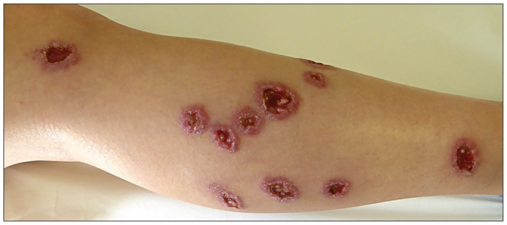 皮膚リーシュマニア症 (Cutaneous Leishmaniasis)