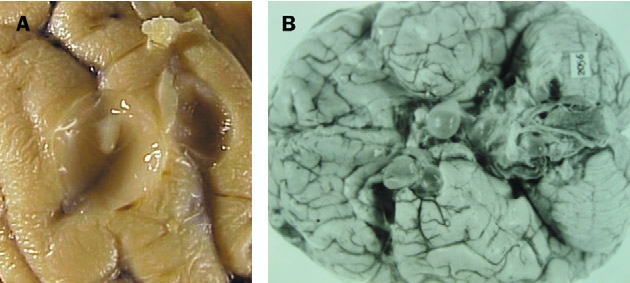 神経嚢虫症 (Neurocysticercosis) 患者から摘出された脳の写真